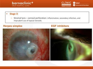 4. Neurotrophic keratitis: Clinical Stages
  • Stage 3:
     – Stromal lysis – corneal perforation: inflammation, secondary infection, and
        imprudent use of topical steroids.

Herpes simplex                                   EGF inhibitors
 