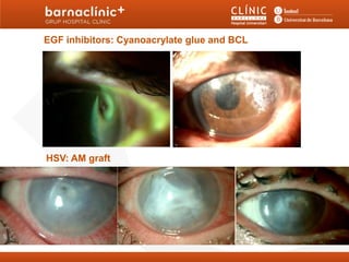 EGF inhibitors: Cyanoacrylate glue and BCL




HSV: AM graft
 