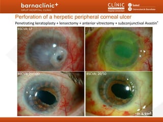 Perforation of a herpetic peripheral corneal ulcer
Penetrating keratoplasty + lensectomy + anterior vitrectomy + subconjunctival Avastin®
 BSCVA: LP




 BSCVA: 20/100                            BSCVA: 20/50




                                                                         Dr. JL Güell
 