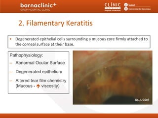 2. Filamentary Keratitis
• Degenerated epithelial cells surrounding a mucous core firmly attached to
  the corneal surface at their base.

Pathophysiology:
– Abnormal Ocular Surface

– Degenerated epithelium

– Altered tear film chemistry
  (Mucous -  viscosity)


                                                                    Dr. JL Güell
 