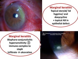 Marginal Infiltrates Non infective keratitis ZOH 2021 | PPT