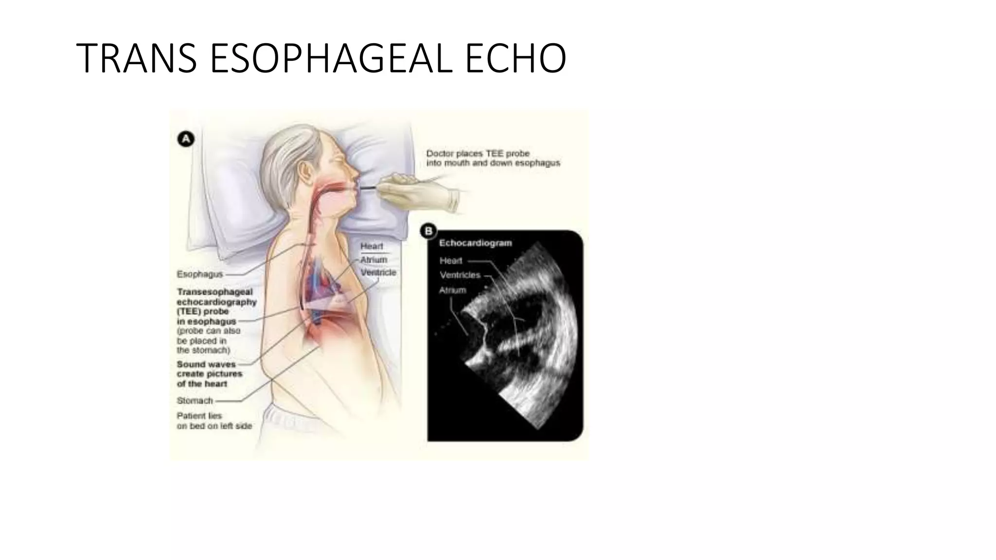 TRANS ESOPHAGEAL ECHO
 