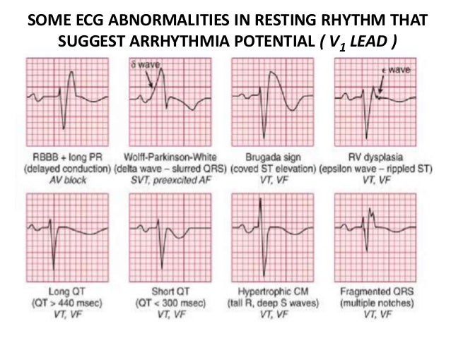 Non Invasive Evaluation Of Arrhythmias Non Invasive Evaluation Of Arrhythmias