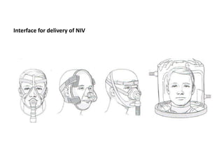 Interface for delivery of NIV
 