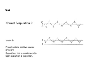 CPAP
Normal Respiration
CPAP 
Provides static positive airway
pressure
throughout the respiratory cycle‐
both nspiration & expiration.
 