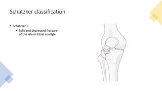 Scthker Classification Nonlocking vs Locking Tibial Plateau Fractures.pptx