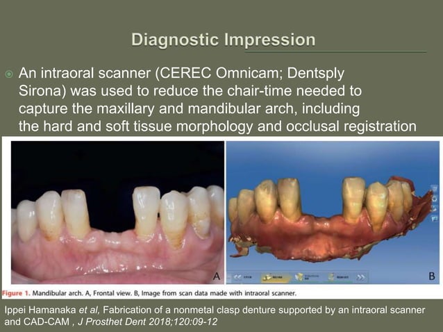 Non-metal clasp removable partial dentures using CAD CAM | PPT