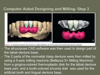 Non-metal clasp removable partial dentures using CAD CAM | PPTX