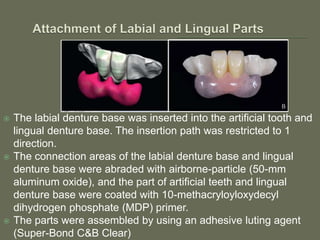 Non-metal clasp removable partial dentures using CAD CAM | PPTX