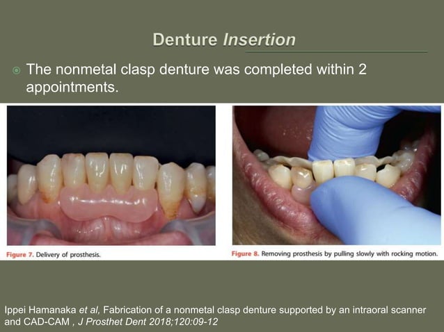Non-metal clasp removable partial dentures using CAD CAM | PPTX ...
