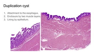 Non neoplastic disorders of esophagus | PPTX