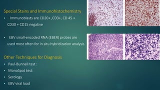 Special Stains and Immunohistochemistry
 Immunoblasts are CD20+ ,CD3+, CD 45 +
CD30 + CD15 negative
 EBV small-encoded RNA (EBER) probes are
used most often for in situ hybridization analysis
Other Techniques for Diagnosis
 Paul-Bunnell test :
 MonoSpot test:
 Serology
 EBV viral load
 
