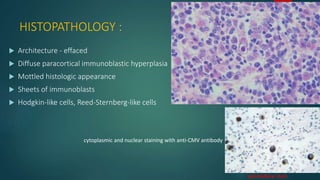 HISTOPATHOLOGY :
 Architecture - effaced
 Diffuse paracortical immunoblastic hyperplasia
 Mottled histologic appearance
 Sheets of immunoblasts
 Hodgkin-like cells, Reed-Sternberg-like cells
cytoplasmic and nuclear staining with anti-CMV antibody
peroxidase stain.
 
