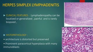 HERPES SIMPLEX LYMPHADENITIS
 CLINICAL FEATURES - Lymphadenopathy can be
localized or generalized , painful and is rarely
biopsied ,
 HISTOPATHOLOGY :
• architecture is distorted but preserved
• Prominent paracortical hyperplasia with many
immunoblasts
 