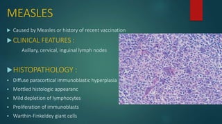 MEASLES
 Caused by Measles or history of recent vaccination
 CLINICAL FEATURES :
Axillary, cervical, inguinal lymph nodes
HISTOPATHOLOGY :
 Diffuse paracortical immunoblastic hyperplasia
 Mottled histologic appearanc
 Mild depletion of lymphocytes
 Proliferation of immunoblasts
 Warthin-Finkeldey giant cells
 