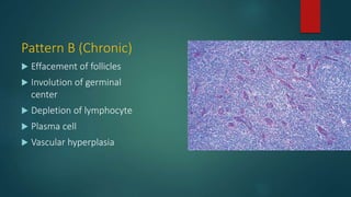 Pattern B (Chronic)
 Effacement of follicles
 Involution of germinal
center
 Depletion of lymphocyte
 Plasma cell
 Vascular hyperplasia
 