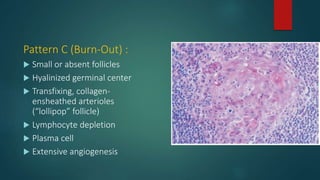Pattern C (Burn-Out) :
 Small or absent follicles
 Hyalinized germinal center
 Transfixing, collagen-
ensheathed arterioles
(“lollipop” follicle)
 Lymphocyte depletion
 Plasma cell
 Extensive angiogenesis
 