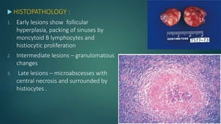  HISTOPATHOLOGY :
1. Early lesions show follicular
hyperplasia, packing of sinuses by
moncytoid B lymphocytes and
histiocytic proliferation
2. Intermediate lesions – granulomatous
changes
3. Late lesions – microabscesses with
central necrosis and surrounded by
histiocytes .
 