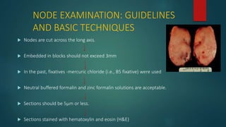 NODE EXAMINATION: GUIDELINES
AND BASIC TECHNIQUES
 Nodes are cut across the long axis.
 Embedded in blocks should not exceed 3mm
 In the past, fixatives -mercuric chloride (i.e., B5 fixative) were used
 Neutral buffered formalin and zinc formalin solutions are acceptable.
 Sections should be 5µm or less.
 Sections stained with hematoxylin and eosin (H&E)
 