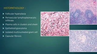 HISTOPATHOLOGY :
 Follicular hyperplasia
 Perivascular lymphoplasmacytic
infiltrate
 Plasma cells in clusters and sheet
 Epithelioid granuloma
 Isolated multinucleated giant cell
 Capsular fibrosis
 