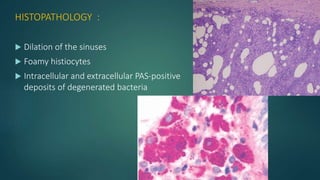 HISTOPATHOLOGY :
 Dilation of the sinuses
 Foamy histiocytes
 Intracellular and extracellular PAS-positive
deposits of degenerated bacteria
 