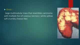  Gross :
large multinodular mass that resembles carcinoma
with multiple foci of caseous necrosis ( white-yellow
soft crumbly cheese-like)
 