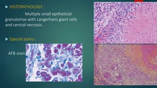  HISTOPATHOLOGY :
Multiple small epithelioid
granulomas with Langerhans giant cells
and central necrosis .
 Special stains :
AFB stain
 