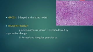  GROSS : Enlarged and matted nodes
 HISTOPATHOLOGY :
granulomatous response is overshadowed by
suppurative change
ill formed and irregular granulomas
 