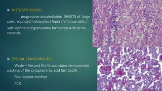  HISTOPATHOLOGY :
progressive accumulation SHEETS of large ,
pale , rounded histiocytes ( lepra / Virchow cells )
with epithelioid granuloma formation with or no
necrosis .
 SPECIAL STAINS AND IHC :
Wade – fite and fite faraco stains demonstrate
packing of the cytoplasm by acid fast bacilli.
Flourescent method
PCR
 