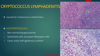 CRYPTOCOCCUS LYMPHADENITIS
 caused by Cryptococcus neoformans.
 HISTOPATHOLOGY :
1. Non-necrotizing granulomas
2. Epithelioid cells and yeast-filled giant cells
3. Cystic areas with gelatinous content
Mucicarmine stain.
 