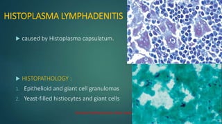 HISTOPLASMA LYMPHADENITIS
 caused by Histoplasma capsulatum.
 HISTOPATHOLOGY :
1. Epithelioid and giant cell granulomas
2. Yeast-filled histiocytes and giant cells
Grocott methenamine silver stain.
 