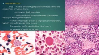  HISTOPATHOLOGY :
Triad - reactive follicular hyperplasia with mitotic activity and
phagocytosis of nuclear debris .
- monocytoid B-cell hyperplasia
- small granulomas composed entirely of epithelioid
histiocytes within germinal centres .
The histiocytes may be present as single cells or small clusters,
typically encroaching on germinal centers
The organism itself is identified in < 1% of cases •
No evidence of significant necrosis
 