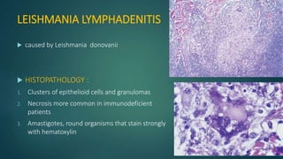 LEISHMANIA LYMPHADENITIS
 caused by Leishmania donovanii
 HISTOPATHOLOGY :
1. Clusters of epithelioid cells and granulomas
2. Necrosis more common in immunodeficient
patients
3. Amastigotes, round organisms that stain strongly
with hematoxylin
 