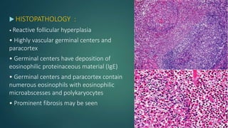  HISTOPATHOLOGY :
• Reactive follicular hyperplasia
• Highly vascular germinal centers and
paracortex
• Germinal centers have deposition of
eosinophilic proteinaceous material (IgE)
• Germinal centers and paracortex contain
numerous eosinophils with eosinophilic
microabscesses and polykaryocytes
• Prominent fibrosis may be seen
 