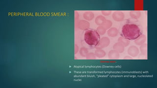 PERIPHERAL BLOOD SMEAR :
 Atypical lymphocytes (Downey cells)
 These are transformed lymphocytes (immunoblasts) with
abundant bluish, “pleated” cytoplasm and large, nucleolated
nuclei
Giemsa stain.
 