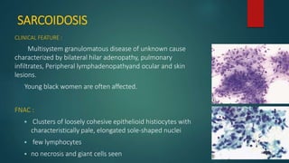SARCOIDOSIS
CLINICAL FEATURE :
Multisystem granulomatous disease of unknown cause
characterized by bilateral hilar adenopathy, pulmonary
infiltrates, Peripheral lymphadenopathyand ocular and skin
lesions.
Young black women are often affected.
FNAC :
 Clusters of loosely cohesive epithelioid histiocytes with
characteristically pale, elongated sole-shaped nuclei
 few lymphocytes
 no necrosis and giant cells seen
 