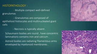 HISTOPATHOLOGY :
- Multiple compact well-defined
granulomas
- Granulomas are composed of
epithelioid histiocytes and multinucleated giant
cells
- Necrosis is typically absent .
- Schaumann bodies are round , have concentric
laminations contains iron and calcium .
- Astroid bodies are radiating filamentous arms
enveloped by myelonoid membranes .
 