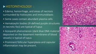 HISTOPATHOLOGY :
• Edema, hemorrhage, and areas of necrosis
surrounded by histiocytes and immunoblasts
• Some cases contain abundant plasma cells
• Hematoxylin bodies (ill-defined purple structures
in necrotic foci) are typical of lupus
• Azzopardi phenomenon (dark blue DNA material
deposited on the basement membrane of blood
vessels) is typical of lupus
• Prominent follicular hyperplasia and capsular
inflammation may be present.
 