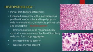 HISTOPATHOLOGY :
 Partial architectural effacement
 Expanded paracortex with a polymorphous
proliferation of smaller and large lymphoid
cells (immunoblasts) , histiocytes ,plasma cells
and eosinophils - Mottled pattern
 Immunoblasts may be morphologically
atypical, sometimes resemble Reed-Sternberg
cells, and form large aggregates
 Increased mitotic activity
 Necrosis may be present
 