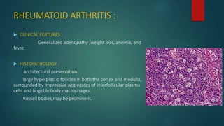 RHEUMATOID ARTHRITIS :
 CLINICAL FEATURES :
Generalized adenopathy ,weight loss, anemia, and
fever.
 HISTOPATHOLOGY :
architectural preservation
large hyperplastic follicles in both the cortex and medulla,
surrounded by impressive aggregates of interfollicular plasma
cells and tingeble body macrophages.
Russell bodies may be prominent.
 