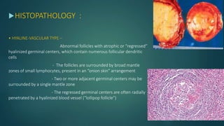 HISTOPATHOLOGY :
• HYALINE-VASCULAR TYPE –
Abnormal follicles with atrophic or “regressed”
hyalinized germinal centers, which contain numerous follicular dendritic
cells
- The follicles are surrounded by broad mantle
zones of small lymphocytes, present in an “onion skin” arrangement
- Two or more adjacent germinal centers may be
surrounded by a single mantle zone
- The regressed germinal centers are often radially
penetrated by a hyalinized blood vessel (“lollipop follicle”)
 