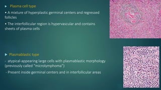  Plasma cell type
• A mixture of hyperplastic germinal centers and regressed
follicles
• The interfollicular region is hypervascular and contains
sheets of plasma cells
 Plasmablastic type
- atypical-appearing large cells with plasmablastic morphology
(previously called “microlymphoma”)
- Present inside germinal centers and in interfollicular areas
 