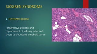 SJÖGREN SYNDROME
 HISTOPATHOLOGY :
progressive atrophy and
replacement of salivary acini and
ducts by abundant lymphoid tissue
 