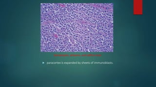  paracortex is expanded by sheets of immunoblasts.
Hematoxylin, phloxine, and saffron stain.
 