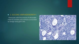  2. SILICONE LYMPHADENOPATHY :
Histiocytes with fine strands of refractable
material probably polyurethane surrounded
by foreign-body giant cells.
 