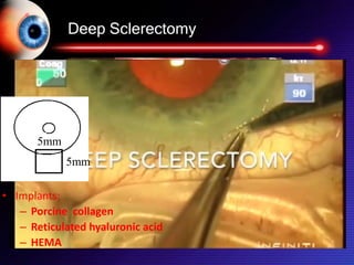 Deep Sclerectomy
5mm
5mm
• Implants:
– Porcine collagen
– Reticulated hyaluronic acid
– HEMA
 