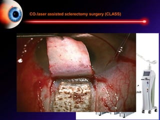 CO2 laser assisted sclerectomy surgery (CLASS)
 