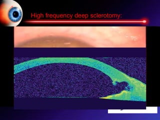 High frequency deep sclerotomy:
High-Frequency Diathermic Probe
-Tip penetrates up to 1mm into
sclera through trabecular meshwork
and Schlemm canal
- Forms deep sclerotomy (0.3 mm high
and 0.6 mm width)
Procedure repeated 6 times
within one quadrant
 
