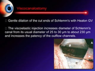 Viscocanalostomy
Gentle dilation of the cut ends of Schlemm's with Healon GV
The viscoelastic injection increases diameter of Schlemm's
canal from its usual diameter of 25 to 30 µm to about 230 µm
and increases the patency of the outflow channels.
 