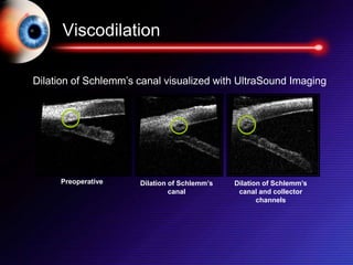Viscodilation
Preoperative Dilation of Schlemm’s
canal
Dilation of Schlemm’s
canal and collector
channels
Dilation of Schlemm’s canal visualized with UltraSound Imaging
 